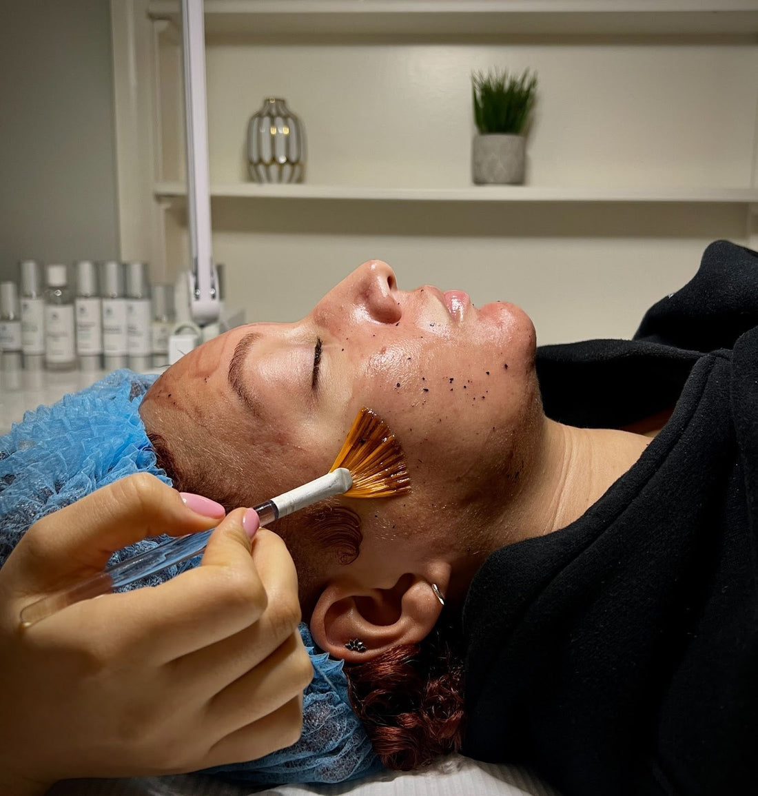 What is Acne Treatment?