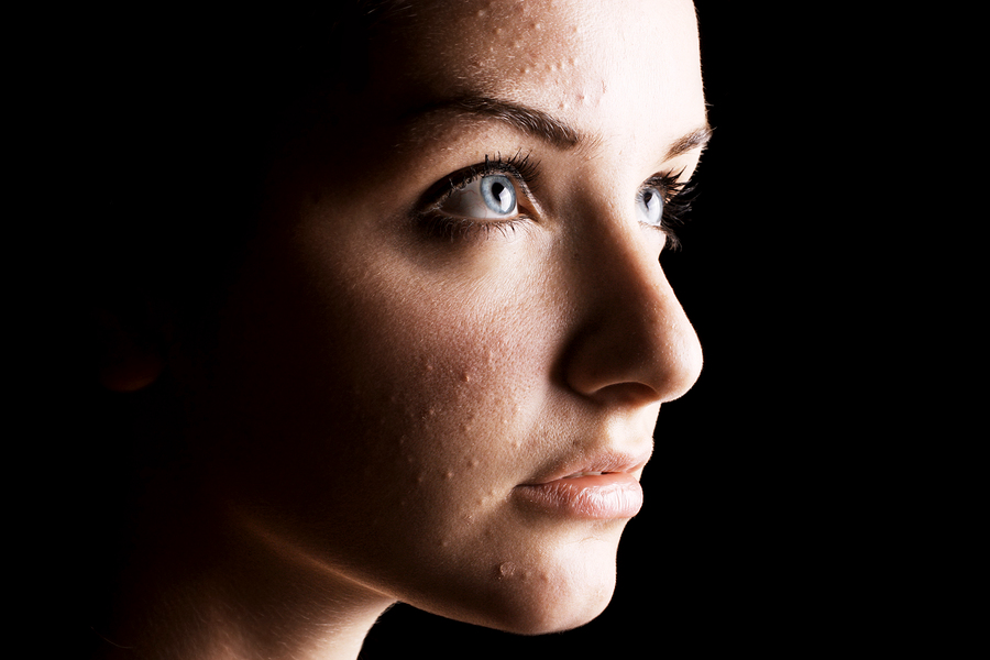 Do You Have Acne That Never Goes Away?
